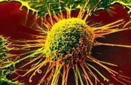 胆管癌扩散到肝传染吗（胆管癌最后会转移到肝吗）