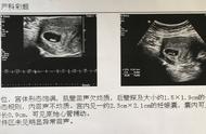 孕期胎心率对照表（孕早期胎心170到180）