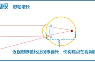 发现自己越来越近视了怎么办（成年人发现自己近视越来越严重）