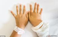 手指肿胀的七种原因是癌症（手胀最快解决方法）