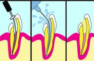 牙髓炎自己用针开髓（牙髓炎不治疗会疼一辈子吗）