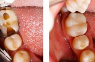 补牙会不会越补越烂（补牙一般能维持几年）