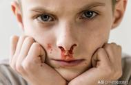 治疗孩子鼻子出血偏方（解决小孩鼻子出血的办法）