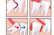 智慧牙发炎流脓严重吗（智慧牙上火反复肿痛必须拔掉吗）