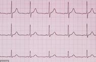 心电图结果窦性心律（正常心电图对照表）
