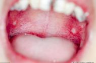 口腔溃疡的图片（口腔癌变的4个征兆图片）