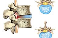 30岁椎间盘突出是不是完了（椎间盘突出是不是一辈子就废了）