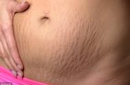 肥胖纹和妊娠纹是一样的（肥胖纹跟妊娠纹看着有什么区别）