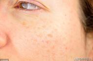 防止起斑的护肤品（容易长斑适合用什么护肤品）