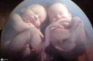 一个孕囊的双胞胎特征（两个孕囊怎么确定双胞胎）