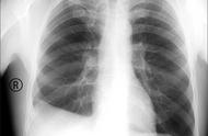 为何肺癌会引起胳膊痛（肺癌胳膊疼是怎么回事）