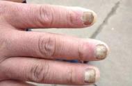 灰指甲是由什么细菌感染的（灰指甲一般是由什么细菌引起的）
