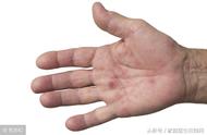 手足口病的前兆是什么症状（手足口怎么鉴别轻重症）