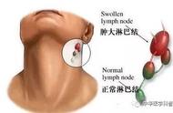 淋巴结在哪个位置图片（淋巴结最怕三种水果）