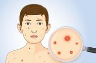 水痘传染一般经过几个阶段（水痘是从哪个阶段开始传染的）