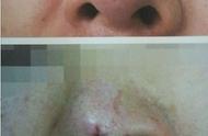 线雕隆鼻过程图片（线雕隆鼻能维持多久）