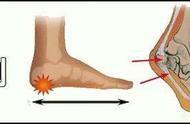 骨刺的最佳治疗方法脚后跟（脚后跟骨刺的最佳治疗方法骨刺平）