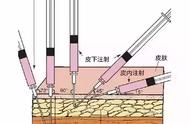 肌肉注射图（肌肉注射小针小视频）