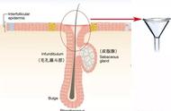 毛孔粗大闭口粉刺怎么彻底去除（闭口粉刺清洁毛孔的最好方法）