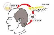 植头发是怎么植的（种植头发哪种方法最好）