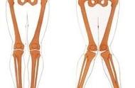 x型腿图片（1-3岁儿童o型腿）