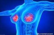 乳房疼痛会是乳腺癌吗（乳腺癌一般哪里疼）