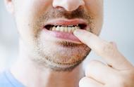 牙周炎牙龈炎是什么症状图片（牙龈炎与牙周炎的判断标准）
