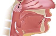 增殖体肥大是微创手术吗（增殖体肥大手术有副作用）