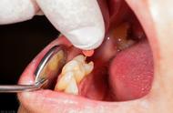 根管治疗多少钱一颗牙（做过根管的牙能用几年）