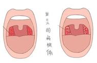 化脓性扁桃体炎脓点几天能消失（化脓性扁桃体炎脓点要多久消除）