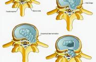 轻型椎间孔骨性狭窄能治愈吗（椎孔狭窄保守治疗有痊愈的吗）