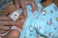 小儿肚脐发炎图片（宝宝肚脐发炎图片及处理方法）