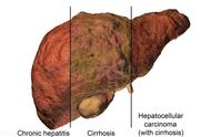 肝硬化的护理（肝硬化最怕三样菜）