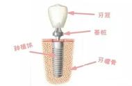 种植牙多久可以正常使用（种植牙过来人经历之谈）