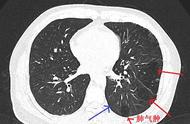肺气肿图片高清图片（肺气肿图片和正常肺对比）
