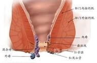 痔疮根源是脾虚（脾虚和痔疮有关么）