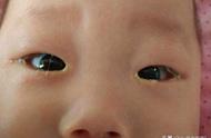 婴儿左眼总流眼屎是怎么回事（新生婴儿左眼一直有眼屎）