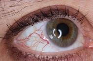 眼睛红血丝图片（眼睛红血丝预示着三大疾病）