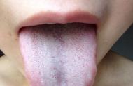 大舌头是什么病的前兆（舌头胖大最快消肿办法）