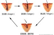 植发后一个月头发几乎掉光了（植发后一个月头发几乎掉光了怎么回事）