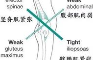 腰肌劳损最有效锻炼方法图解（腰肌劳损最好的治疗方法）