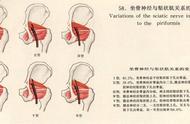 坐骨大孔与坐骨小孔位置图（坐骨大孔与坐骨小孔解剖图）