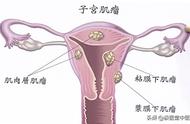 吃什么子宫肌瘤会消除（子宫肌瘤的克星）