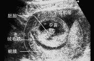 50天看不到胎心胎芽正常吗（11周未见胎心12周有了）
