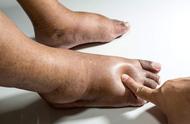 老人脚肿了是什么征兆（95岁老年人脚肿是快死的征兆吗）