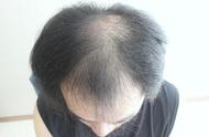 种植头发五个月了什么效果（种植头发靠谱吗）