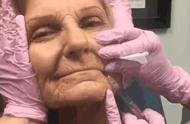 注射玻尿酸脸部抗衰老方法（经常打玻尿酸面部会衰老得更快吗）