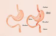 胃溃疡和十二指肠溃疡的区别（胃溃疡与十二指肠溃疡哪个好得快）