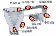 导致宫外孕的八个原因（引发宫外孕的主要原因）