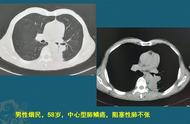 免疫组化ck+是癌症吗（免疫组化结果怎么看是患癌了）